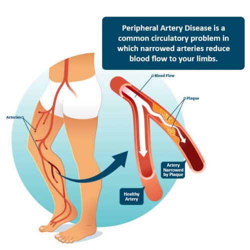 PAD - Peripheral Artery Disease diagnosis and treatment in Tulsa, OK