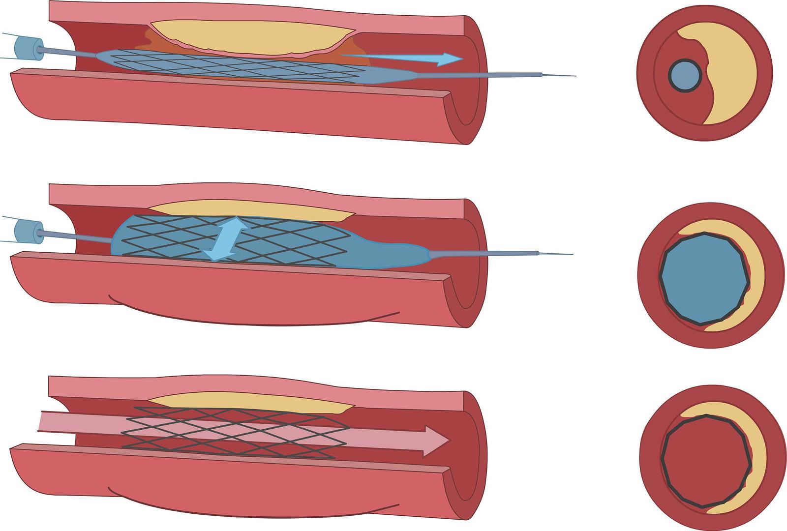 Endovascular Angioplasty and Stent Example Image - Tulsa Cardiovascular 
